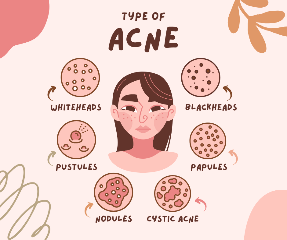 Types, Causes, and Treatments for Acne